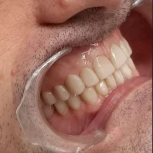 EROSIÓN FIN PERFIL