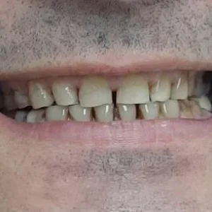 EROSIÓN SONRISA