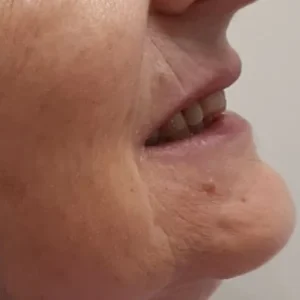 ESTET ANT PERFIL CARA