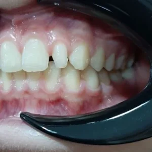 ESTETICA DIENTE CONOIDE 2