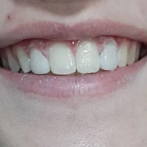 ESTETICA DIENTE CONOIDE FIN