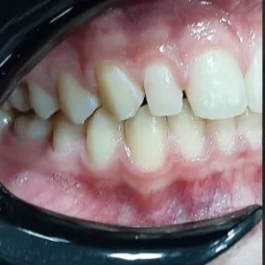 ESTETICA DIENTE CONOIDE