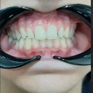 ESTETICA DIENTES CONOIDES