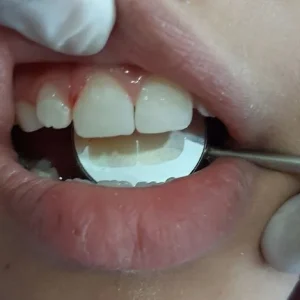 FRACT PEDIAT FINAL ESTETICO