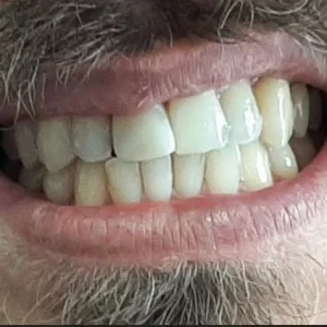 FRACTURA DENT ADULTO RESINA