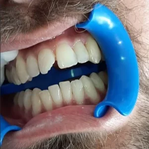 FRACTURA DENT ADULTO