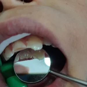 FRACTURA PEDIATRICA