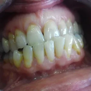 ORTODONCIA ADULTO INICIAL