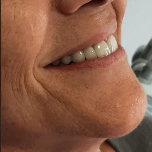 PUENTE ESTETICO IMPLANT PERFIL