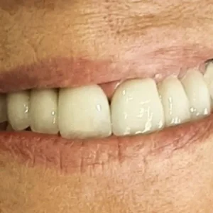 PUENTE ESTETICO IMPLANTES